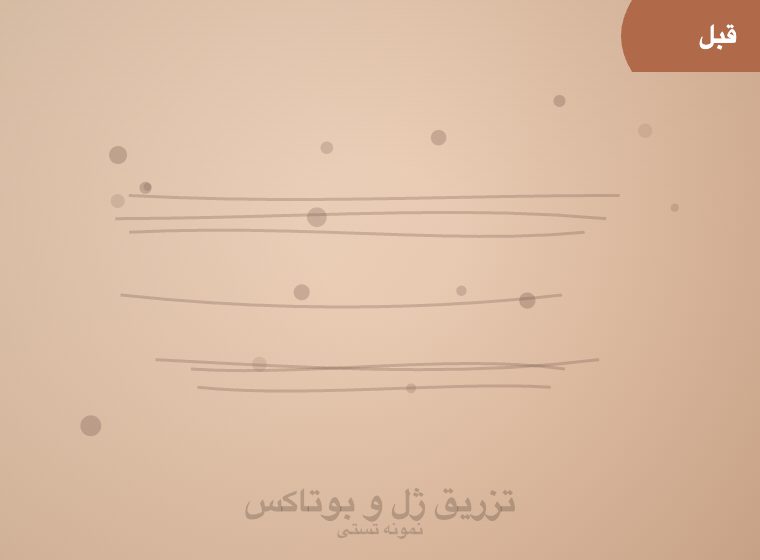 قبل: تزریق ژل گونه