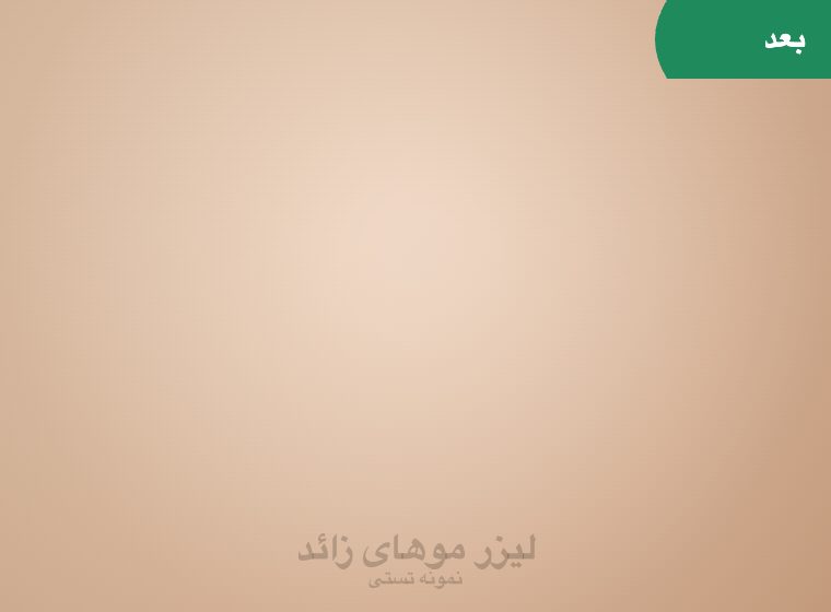 بعد: لیزر ساق پا