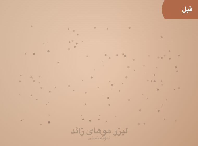قبل: لیزر ساق پا
