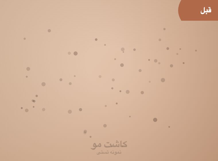 قبل: نمونه نتیجه تقویت مو – کرمانشاه