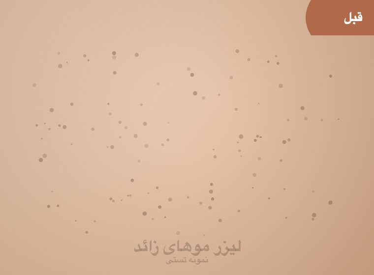 اتاق لیزر