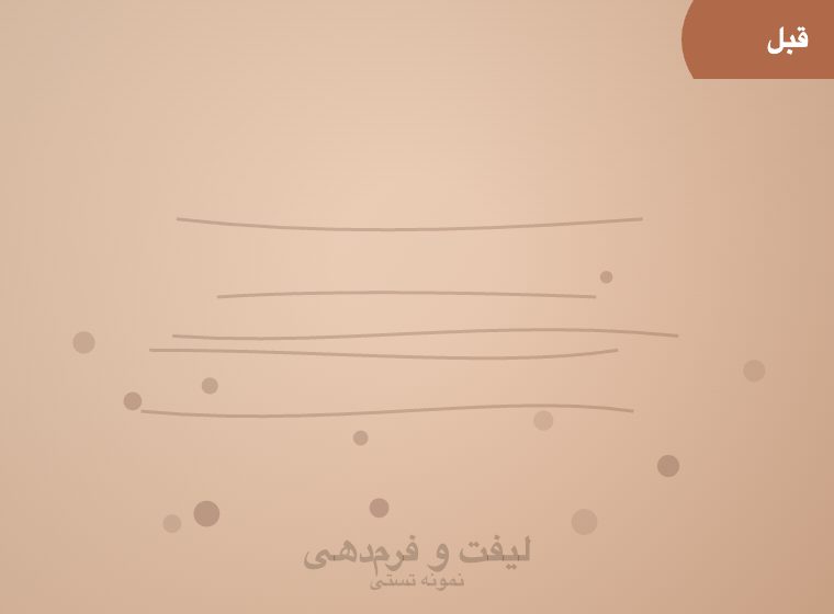 اتاق لیزر