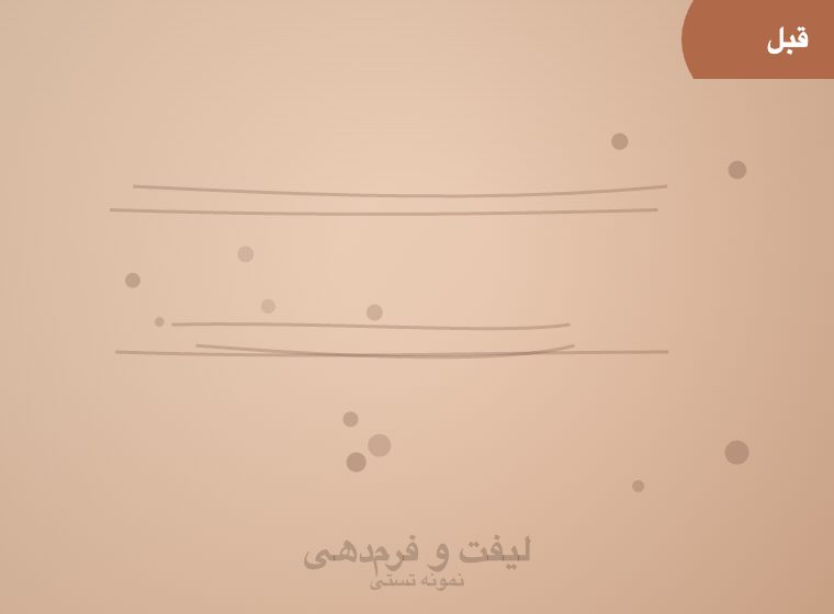 اتاق لیزر